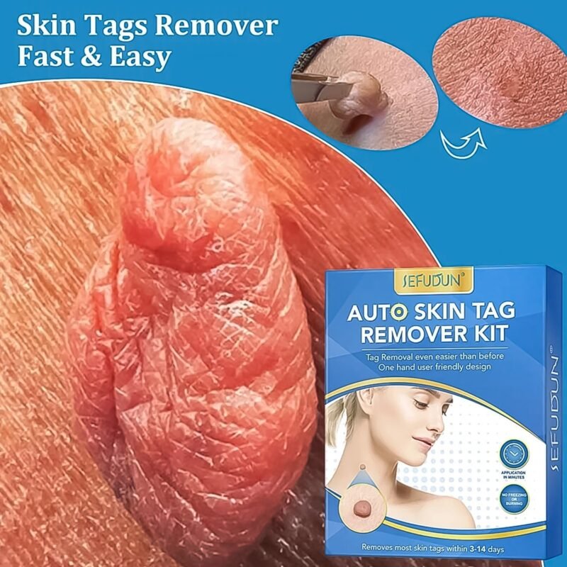 03_b2812fb7-e89a-40b9-9bd8-6853fc903500.jpg Skin Tag Remover Kit 2-in-1 � Painless Home Use | Arrive Kit