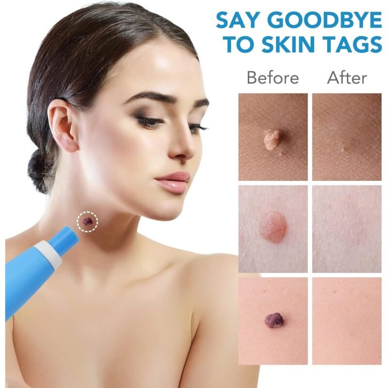 05_d145ff50-331e-4514-8cca-9d9e247c9cda.jpg Skin Tag Remover Kit 2-in-1 � Painless Home Use | Arrive Kit